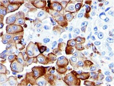 Immunohistochemistry-Paraffin: NGFR/TNFRSF16/p75NTR Antibody (NGFR5) - Azide and BSA Free [NBP2-47965] - Human Melanoma stained with NGFR Mouse Monoclonal Antibody (NGFR5).