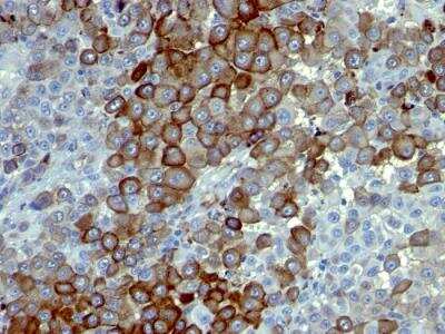 Immunohistochemistry-Paraffin: NGFR/TNFRSF16/p75NTR Antibody (NTR/912) - Azide and BSA Free [NBP2-47966] - Human Melanoma stained with NGFR Monoclonal Antibody (NTR/912).