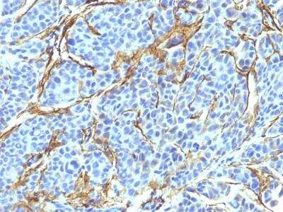 Immunohistochemistry-Paraffin: NGFR/TNFRSF16/p75NTR Antibody (NTR/912) - IHC-Prediluted [NBP2-48297] - Human Melanoma stained with NGFR Monoclonal Antibody (NTR/912).