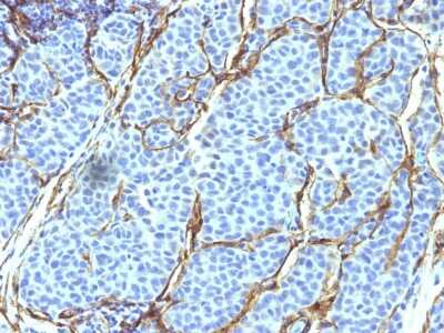 Immunohistochemistry-Paraffin: NGFR/TNFRSF16/p75NTR Antibody (SPM299) - Azide and BSA Free [NBP3-11470] - Formalin-fixed, paraffin-embedded human Melanoma stained with NGFR/TNFRSF16/p75NTR Antibody (SPM299).