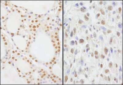 Immunohistochemistry: NIF1 Antibody [NB100-2578] - Sample: FFPE section of human thyroid carcinoma (left) and mouse squamous cell carcinoma (right). Antibody: Affinity purified rabbit anti-NIF1 used at a dilution of 1:5,000 (0.2ug/ml). Detection: DAB