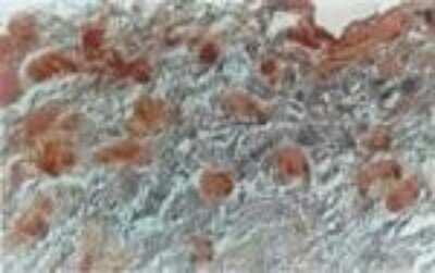 Immunohistochemistry: NIFK Antibody [NB100-56660] - Staining in adipocytes of human carcinomatus breast tissue using NB100-56660 at 1:500 dilution.