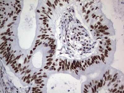 Immunohistochemistry: NIPP1 Antibody (4E5) [NBP2-45386] - Analysis of Adenocarcinoma of Human colon tissue. (Heat-induced epitope retrieval by 1 mM EDTA in 10mM Tris, pH8.5, 120C for 3min)