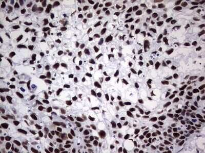 Immunohistochemistry: NIPP1 Antibody (4E5) [NBP2-45386] - Analysis of Carcinoma of Human kidney tissue. (Heat-induced epitope retrieval by 1 mM EDTA in 10mM Tris, pH8.5, 120C for 3min)