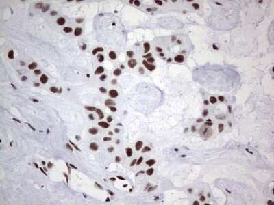 Immunohistochemistry: NIPP1 Antibody (4E5) [NBP2-45386] - Analysis of Carcinoma of Human liver tissue.(Heat-induced epitope retrieval by 1 mM EDTA in 10mM Tris, pH8.5, 120C for 3min)