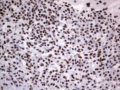 Immunohistochemistry: NIPP1 Antibody (4E5) [NBP2-45386] - Analysis of Carcinoma of Human lung tissue.(Heat-induced epitope retrieval by 1 mM EDTA in 10mM Tris, pH8.5, 120C for 3min)