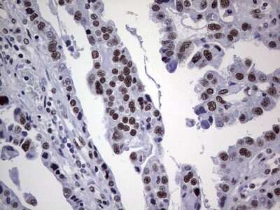 Immunohistochemistry: NIPP1 Antibody (4E5) [NBP2-45386] - Analysis of Adenocarcinoma of Human ovary tissue. (Heat-induced epitope retrieval by 1 mM EDTA in 10mM Tris, pH8.5, 120C for 3min)