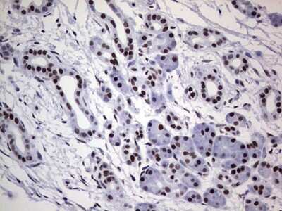 Immunohistochemistry: NIPP1 Antibody (4E5) [NBP2-45386] - Analysis of Carcinoma of Human pancreas tissue. (Heat-induced epitope retrieval by 1 mM EDTA in 10mM Tris, pH8.5, 120C for 3min)