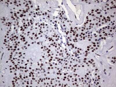 Immunohistochemistry: NIPP1 Antibody (4E5) [NBP2-45386] - Analysis of Carcinoma of Human thyroid tissue. (Heat-induced epitope retrieval by 1 mM EDTA in 10mM Tris, pH8.5, 120C for 3min)