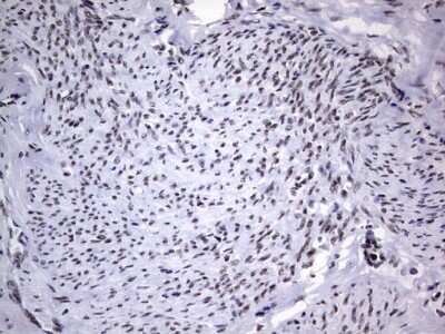 Immunohistochemistry: NIPP1 Antibody (4E5) [NBP2-45386] - Analysis of Adenocarcinoma of Human endometrium tissue. (Heat-induced epitope retrieval by 1 mM EDTA in 10mM Tris, pH8.5, 120C for 3min)