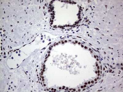 Immunohistochemistry: NIPP1 Antibody (4E5) [NBP2-45386] - Analysis of Carcinoma of Human prostate tissue. (Heat-induced epitope retrieval by 1 mM EDTA in 10mM Tris, pH8.5, 120C for 3min)