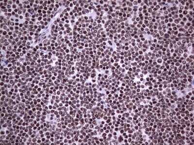 Immunohistochemistry: NIPP1 Antibody (4E5) [NBP2-45386] - Analysis of Human lymphoma tissue. (Heat-induced epitope retrieval by 1 mM EDTA in 10mM Tris, pH8.5, 120C for 3min)