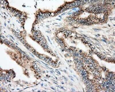 Immunohistochemistry: NIT2 Antibody (OTI2B9) - Azide and BSA Free [NBP2-72995] - Staining of paraffin-embedded Adenocarcinoma of colon tissue using anti-NIT2 mouse monoclonal antibody.