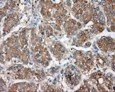 Immunohistochemistry: NIT2 Antibody (OTI2B9) - Azide and BSA Free [NBP2-72995] - Staining of paraffin-embedded Carcinoma of liver tissue using anti-NIT2 mouse monoclonal antibody.