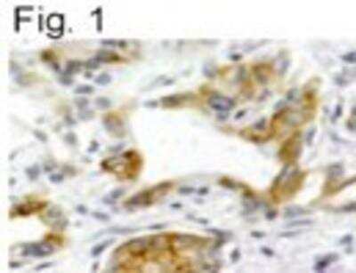 Immunohistochemistry: NK1R Antibody [NB100-74469] - Staining of  NK1R from paraffin embedded human pancreatic carcinoma tissue sections.