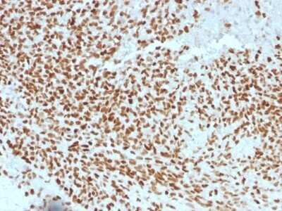 Immunohistochemistry-Paraffin: NKX2.2 Antibody (NX2/1523) - Azide and BSA Free [NBP2-54328] - Formalin-fixed, paraffin-embedded human Ewing's Sarcoma stained with NKX2.2 Monoclonal Antibody (NX2/1523).