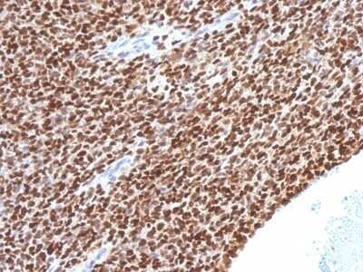 Immunohistochemistry-Paraffin: NKX2.2 Antibody (NX2/1524) - Azide and BSA Free [NBP2-54323] - Formalin-fixed, paraffin-embedded human Ewing's Sarcoma stained with NKX2.2 Monoclonal Antibody (NX2/1524).