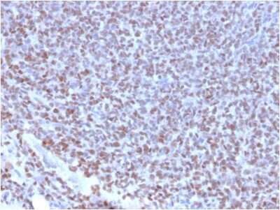 Immunohistochemistry-Paraffin: NKX2.2 Antibody (NX2/2198R) [NBP3-07410] - Formalin-fixed, paraffin-embedded human Ewing's Sarcoma stained with NKX2.2 Rabbit Recombinant Monoclonal Antibody (NX2/2198R).