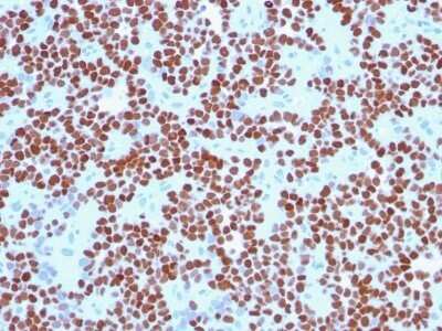 Immunohistochemistry-Paraffin: NKX2.2 Antibody (NX2/294) - Azide and BSA Free [NBP2-33058] - Formalin-fixed, paraffin-embedded human Ewing's Sarcoma stained with NKX2.2 Antibody (NX2/294).