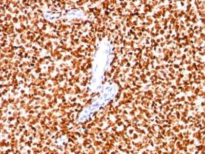 Immunohistochemistry-Paraffin: NKX2.2 Antibody (SPM564) - Azide and BSA Free [NBP2-34799] - Formalin-paraffin Ewings sarcoma stained with NKX2.2 MAb (SPM564).