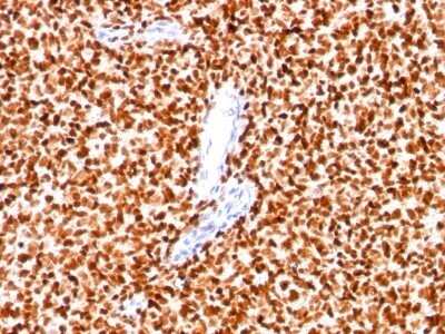 Immunohistochemistry-Paraffin: NKX2.2 Antibody (SPM564) - IHC-Prediluted [NBP2-45155] - Formalin-paraffin Ewings sarcoma stained with NKX2.2 MAb (SPM564).