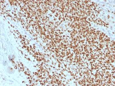 Immunohistochemistry-Paraffin: NKX2.2 Antibody (rNX2/1523) - Azide and BSA Free [NBP3-08567] - Formalin-fixed, paraffin-embedded human Ewing's Sarcoma stained with NKX2.2 Mouse Recombinant Monoclonal Antibody (rNX2/1523).