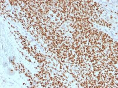 Immunohistochemistry-Paraffin: NKX2.2 Antibody (rNX2/1523) [NBP3-07409] - Formalin-fixed, paraffin-embedded human Ewing's Sarcoma stained with NKX2.2 Mouse Recombinant Monoclonal Antibody (rNX2/1523).