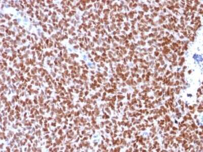 Immunohistochemistry-Paraffin: NKX2.2 Antibody (rNX2/294) - Azide and BSA Free [NBP2-54345] - Formalin-fixed, paraffin-embedded human Ewing's Sarcoma stained with NKX2.2 Recombinant Mouse Monoclonal Antibody (rNX2/294).