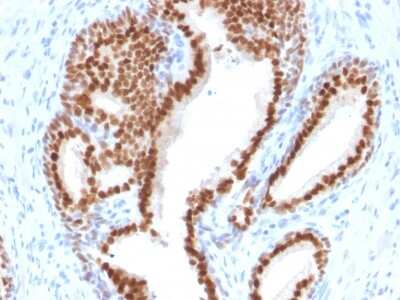 Immunohistochemistry-Paraffin: NKX3.1 Antibody (NKX3.1/2576) [NBP2-79736] - Formalin-fixed, paraffin-embedded human Prostate Carcinoma stained with NKX3.1 Antibody (NKX3.1/2576).