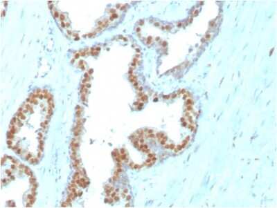 Immunohistochemistry-Paraffin: NKX3.1 Antibody (NKX3.1/3347) [NBP3-07436] - Formalin-fixed, paraffin-embedded human Prostate Carcinoma stained with NKX3.1-Monospecific Mouse Monoclonal Antibody (NKX3.1/3347).