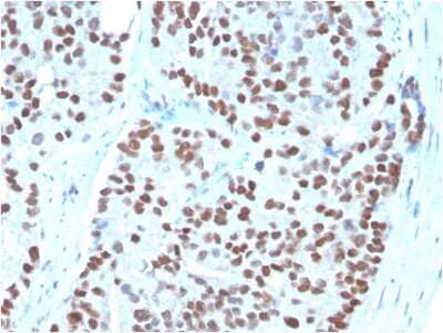 Immunohistochemistry-Paraffin: NKX3.1 Antibody (NKX3.1/3348) [NBP3-08682] - Formalin-fixed, paraffin-embedded human Prostate Carcinoma stained with NKX3.1-Monospecific Mouse Monoclonal Antibody (NKX3.1/3348).