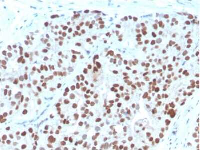 Immunohistochemistry-Paraffin: NKX3.1 Antibody (NKX3.1/3348) [NBP3-08682] - Formalin-fixed, paraffin-embedded human Prostate Carcinoma stained with NKX3.1-Monospecific Mouse Monoclonal Antibody (NKX3.1/3348).