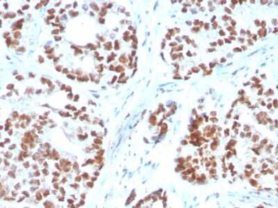 Immunohistochemistry-Paraffin: NKX3.1 Antibody (NKX3.1/3350) [NBP3-07411] - Formalin-fixed, paraffin-embedded human Prostate Carcinoma stained with NKX3.1 Mouse Monoclonal Antibody (NKX3.1/3350).