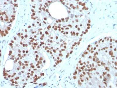 Immunohistochemistry-Paraffin: NKX3.1 Antibody (NKX3.1/3350) [NBP3-08572] - Formalin-fixed, paraffin-embedded human Prostate Carcinoma stained with NKX3.1 Mouse Monoclonal Antibody (NKX3.1/3350).