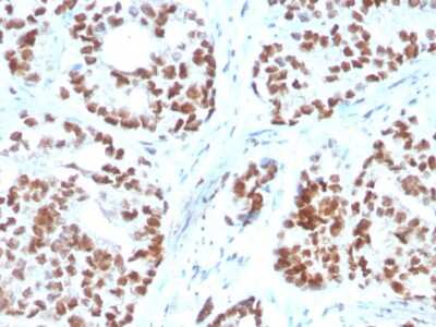 Immunohistochemistry-Paraffin: NKX3.1 Antibody (NKX3.1/3350) [NBP3-08572] - Formalin-fixed, paraffin-embedded human Prostate Carcinoma stained with NKX3.1 Mouse Monoclonal Antibody (NKX3.1/3350).