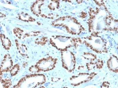 Immunohistochemistry-Paraffin: NKX3.1 Antibody (NKX3.1/4562R) - Azide and BSA Free [NBP3-08744] - Formalin-fixed, paraffin-embedded human prostate stained with NKX3.1 Recombinant Rabbit Monoclonal Antibody (NKX3.1/4562R).