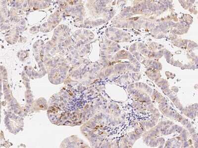 Immunohistochemistry-Paraffin: NKX6.1 Antibody [NBP2-99125] - Immunochemical staining of human NKX6.1 in human thyroid carcinoma with rabbit polyclonal antibody (1:500, formalin-fixed paraffin embedded sections).