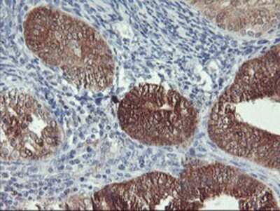 Immunohistochemistry-Paraffin: NLN Antibody (1D6) [NBP2-01693] - Staining of paraffin-embedded Adenocarcinoma of Human endometrium tissue using anti-NLN mouse monoclonal antibody.