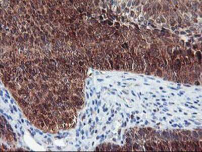 Immunohistochemistry-Paraffin: NLN Antibody (1D6) [NBP2-01693] - Staining of paraffin-embedded Carcinoma of Human bladder tissue using anti-NLN mouse monoclonal antibody.