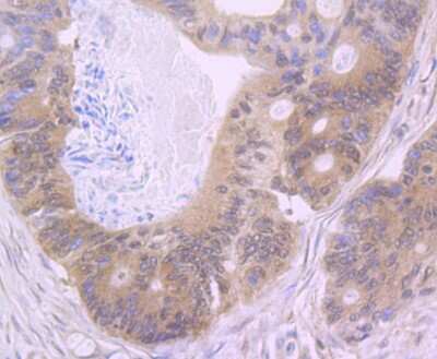 Immunohistochemistry-Paraffin: NLRC3 Antibody [NBP2-75593] - Analysis of paraffin-embedded human colon cancer tissue using anti-NLRC3 antibody. Counter stained with hematoxylin.