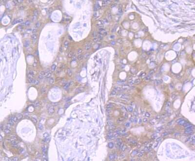 Immunohistochemistry-Paraffin: NLRC3 Antibody [NBP2-75594] - Analysis of paraffin-embedded human colon cancer tissue using anti-NLRC3 antibody. Counter stained with hematoxylin.