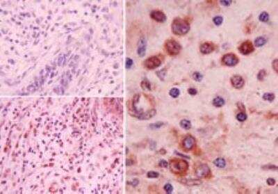 Immunohistochemistry-Paraffin: NLRP2/NALP2 Antibody [NBP2-24667] - Analysis of NALP2 in formalin-fixed, paraffin-embedded human colon tumor tissue using an isotype control (top left) and this antibody (bottom left, right) at 5 ug/ml.