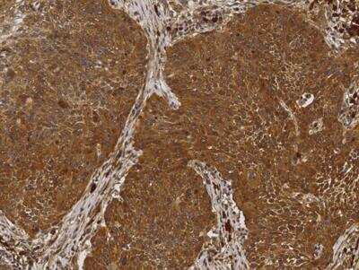 Immunohistochemistry-Paraffin: NM23-H1 Antibody (084) [NBP2-89930] - Staining of human NME1 in human lung cancer with rabbit monoclonal antibody (1:200).