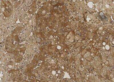 Immunohistochemistry-Paraffin: NM23-H1 Antibody (084) [NBP2-89930] - Staining of human NME1 in human hepatoma with rabbit monoclonal antibody (1:200).