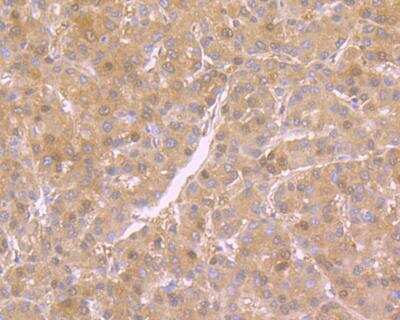 Immunohistochemistry: NM23-H1 Antibody (12A1) [NBP2-76900] - Immunohistochemical analysis of paraffin-embedded human liver cancer tissue using anti-NM23 antibody. The section was pre-treated using heat mediated antigen retrieval with sodium citrate buffer (pH 6.0) for 20 minutes. The tissues were blocked in 5% BSA for 30 minutes at room temperature, washed with ddH2O and PBS, and then probed with the antibody at 1/200 dilution, for 30 minutes at room temperature and detected using an HRP conjugated compact polymer system. DAB was used as the chrogen. Counter stained with hematoxylin and mounted with DPX.