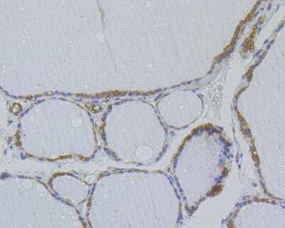 Immunohistochemistry: NM23-H1 Antibody (12A1) [NBP2-76900] - Immunohistochemical analysis of paraffin-embedded human thyroid gland tissue using anti-NM23 antibody. The section was pre-treated using heat mediated antigen retrieval with sodium citrate buffer (pH 6.0) for 20 minutes. The tissues were blocked in 5% BSA for 30 minutes at room temperature, washed with ddH2O and PBS, and then probed with the antibody at 1/200 dilution, for 30 minutes at room temperature and detected using an HRP conjugated compact polymer system. DAB was used as the chrogen. Counter stained with hematoxylin and mounted with DPX.