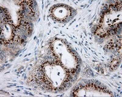 Immunohistochemistry: NME4 Antibody (OTI1A5) - Azide and BSA Free [NBP2-73005] - Staining of paraffin-embedded Adenocarcinoma of colon tissue using anti-NME4 mouse monoclonal antibody.