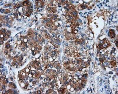 Immunohistochemistry: NME4 Antibody (OTI1A5) - Azide and BSA Free [NBP2-73005] - Staining of paraffin-embedded Carcinoma of liver tissue using anti-NME4 mouse monoclonal antibody.