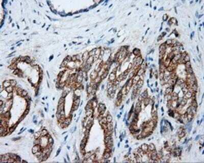 Immunohistochemistry: NME4 Antibody (OTI1A5) - Azide and BSA Free [NBP2-73005] - Staining of paraffin-embedded Carcinoma of prostate tissue using anti-NME4 mouse monoclonal antibody.