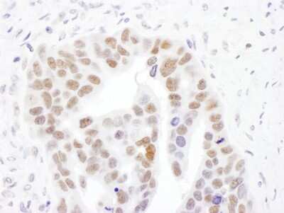 <b>Biological Strategies Validation. </b>Immunohistochemistry-Paraffin: NMNAT-1 Antibody [NBP2-32107] - Section of human ovarian carcinoma. Antibody: Affinity purified rabbit anti- NMNAT1 used at a dilution of 1:1,000 (1ug/ml). Detection: DAB. Counterstain: IHC Hematoxylin (blue).